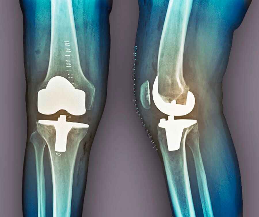 3-total-knee-replacement-zephyrscience-photo-library (1)