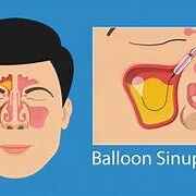 balloon_sinuplasty_1x1 (1)