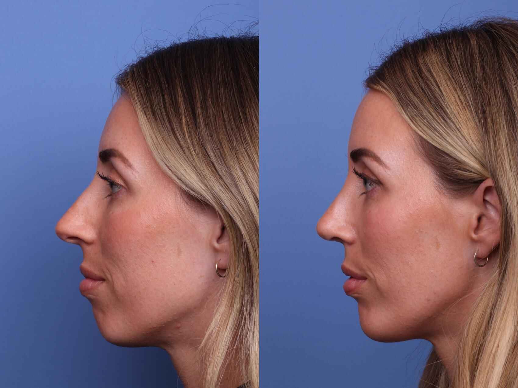 rhinoplasty-514-left-side-detail (1)